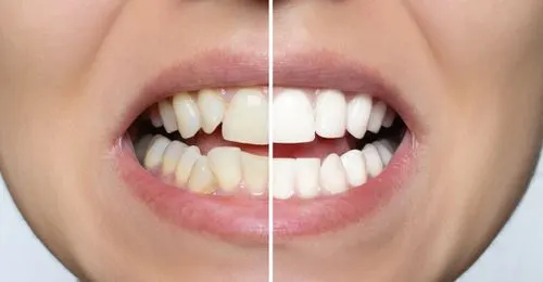 Comparação antes e depois de dentes com facetas de porcelana
