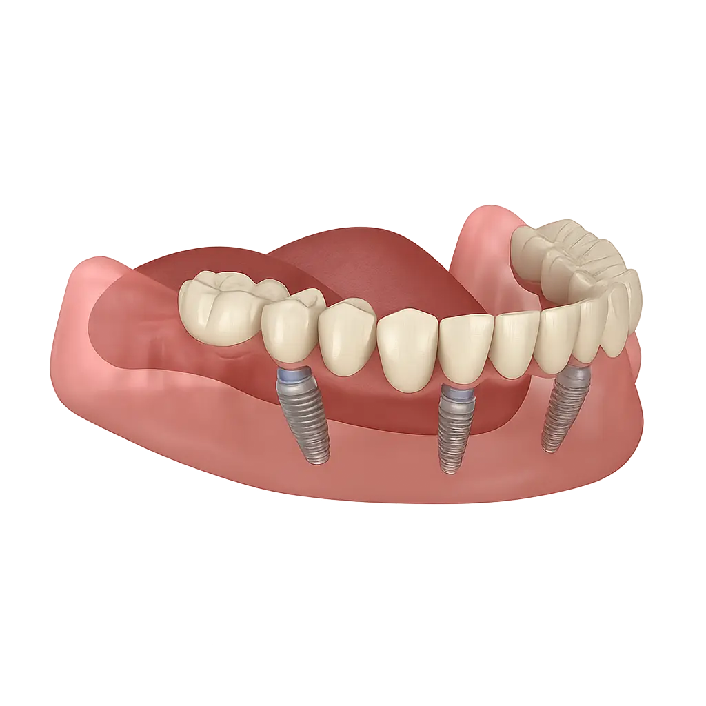 Ilustração 3D de arcada dentária com implantes dentários
